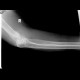 Supracondylic fracture of humerus: X-ray - Plain radiograph